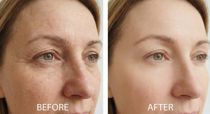 The “Calcium-Infused” Roller That Tightens “Crepey” Eyelids Without Surgery