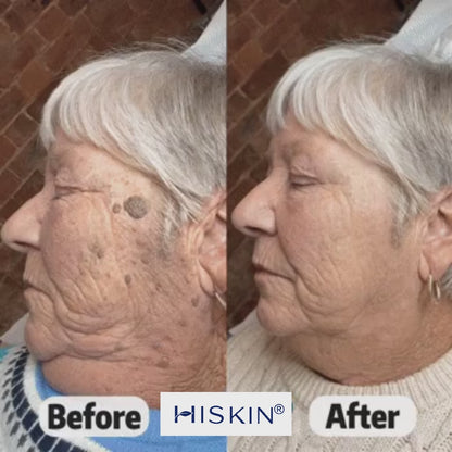 𝐇𝐈𝐒𝐊𝐈𝐍®👩‍⚕️ 𝟕-𝐃𝒂𝘆 𝐒𝗸𝐢𝐧 𝐓𝒂𝗴 & 𝐒𝐩𝙤𝐭 𝐄𝐫𝒂𝐬𝙚𝐫 Painless & Scar-Free Advanced Imperfection Removal Rollerball Pen
